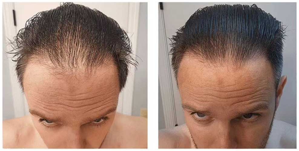 more-hair-naturally-results more hair rezultati